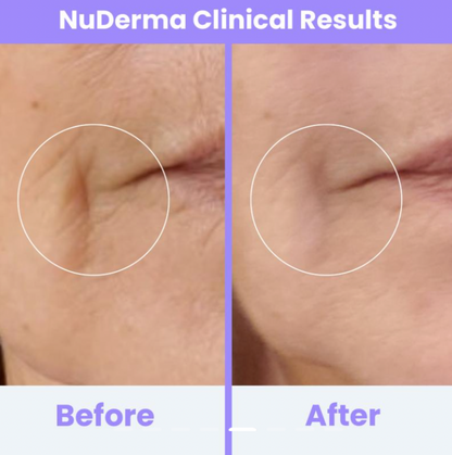 PurePulse Beauty Radiant Glow High Frequency Skincare System™