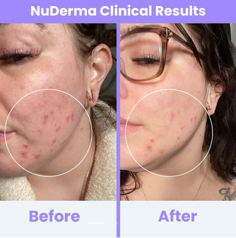 PurePulse Beauty Radiant Glow High Frequency Skincare System™