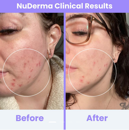 PurePulse Beauty Radiant Glow High Frequency Skincare System™